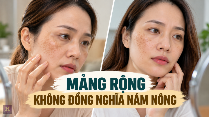 Mảng Rộng Không Đồng Nghĩa Nám Nông