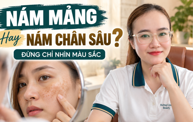 Nám Mảng Hay Nám Chân Sâu