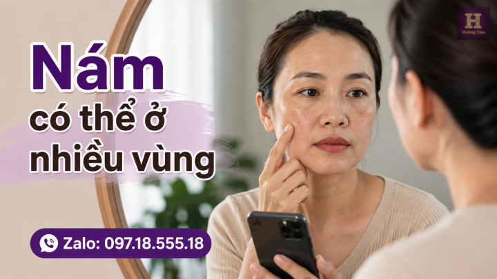 Nám có thể ở nhiều vùng Nám có thể ở nhiều vùng