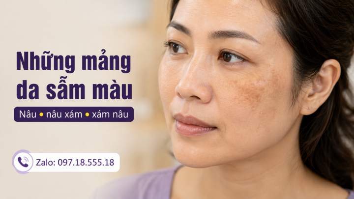 Nám da thường biểu hiện như thế nào Nám da thường biểu hiện như thế nào