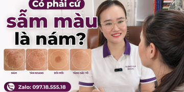 Nám không phải đốm nâu nào cũng giống nhau