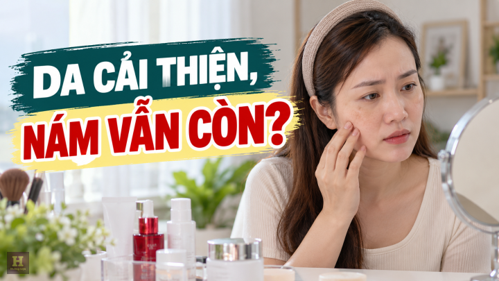Da cải thiện, nám vẫn còn