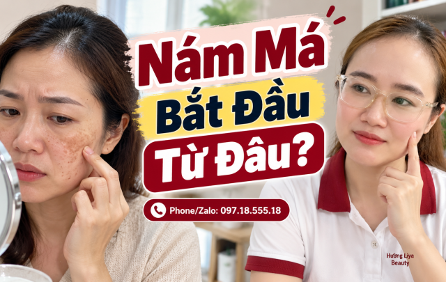 Làm cách nào để trị nám nhẹ 2 bên gò má?