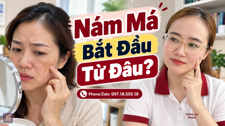 Làm cách nào để trị nám nhẹ 2 bên gò má?