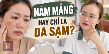 Nám Mảng Là Gì? Dấu Hiệu Nhận Biết Trên Da Mặt