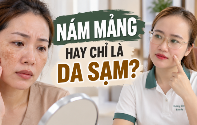 Nám Mảng Là Gì? Dấu Hiệu Nhận Biết Trên Da Mặt
