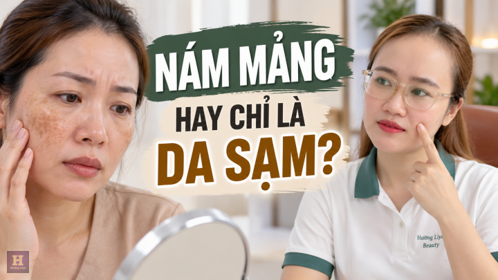 Nám Mảng Là Gì? Dấu Hiệu Nhận Biết Trên Da Mặt Nám Mảng Là Gì? Dấu Hiệu Nhận Biết Trên Da Mặt