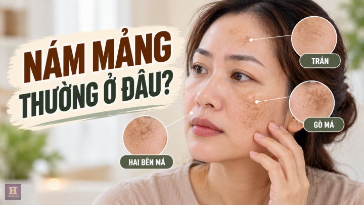 Nám mảng thường xuất hiện ở đâu Nám mảng thường xuất hiện ở đâu