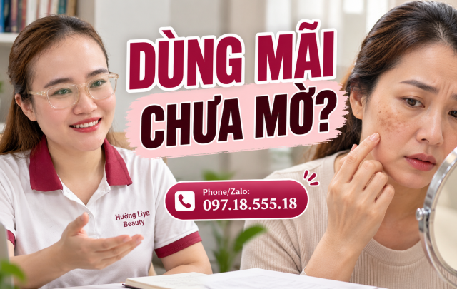Top 6 kem trị nám tốt nhất, So sánh gì trước khi chọn?